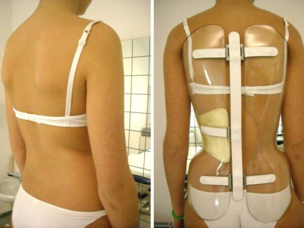 La sedia per la scoliosi: storia di una terapia senza evidenza scientifica