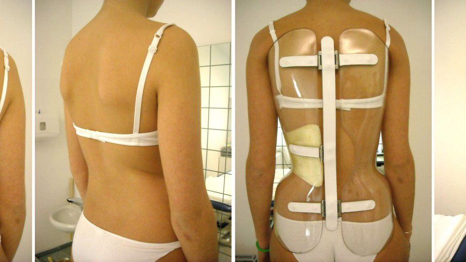 La sedia per la scoliosi: storia di una terapia senza evidenza scientifica