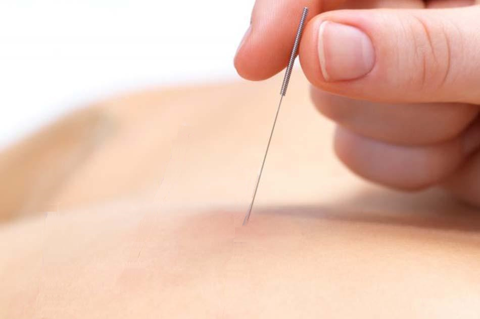 Corso ISICO sul dry-needling